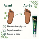 Load image into Gallery viewer, Crème contre le pied d’athlètes et la mycose des pieds RCA
